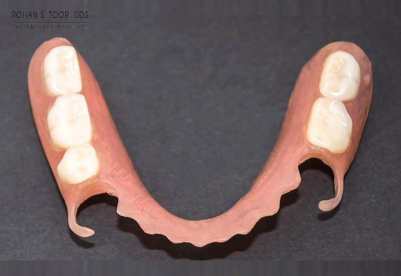Acrylic clasp removable partial dentures