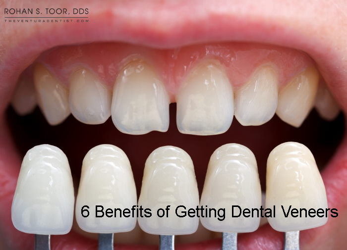 6 Benefits of Getting Dental Veneers