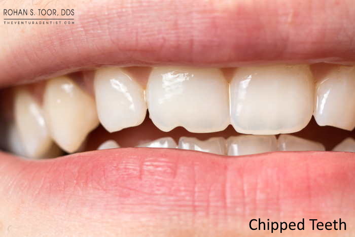 How to Prepare and Repair a Chipped or Broken Tooth