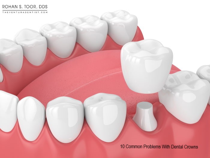 Problems With Dental Crowns