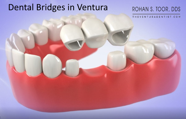 Dental Bridge in Ventura