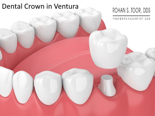 Dental Crowns in Ventura