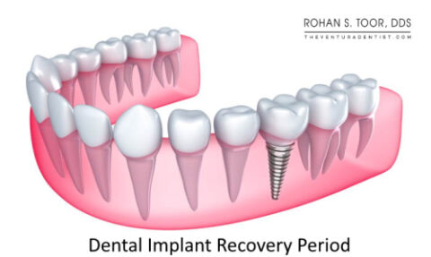Dental Implant Recovery Period