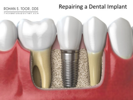 Repairing a Dental Implant