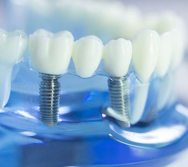 Ventura Dental Implants