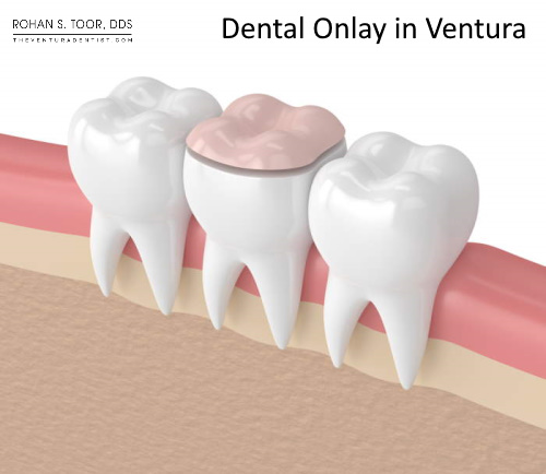 Dr. Rohan S. Toor Dental Onlay Provider for Ventura community