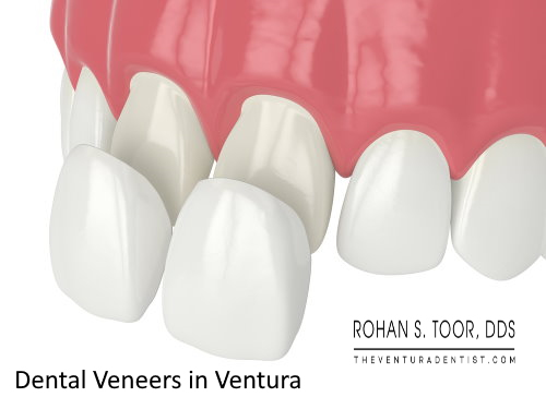 Dental Veneers in Ventura