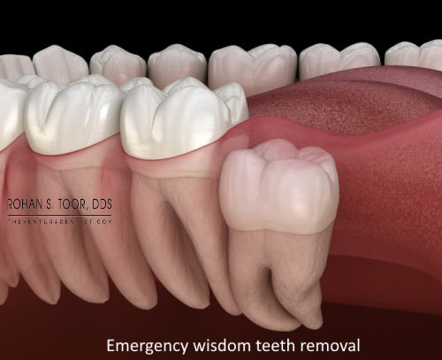 Emergency wisdom teeth removal in Ventura