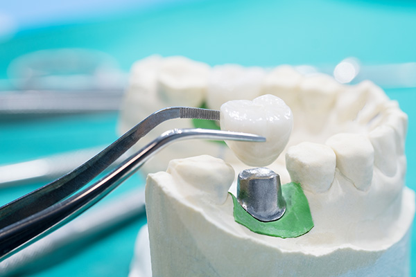 General Dentistry Solutions Using Dental Crowns from Rohan S. Toor, DDS & David M. Satnick, DMD in Ventura, CA