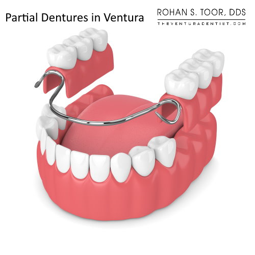 Partial Dentures in Ventura