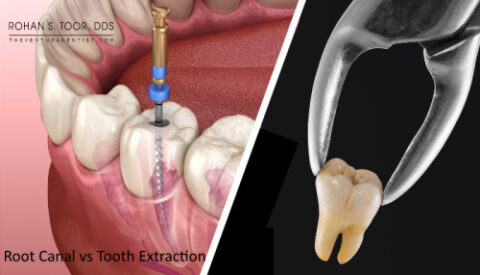 Root Canal vs Tooth Extraction