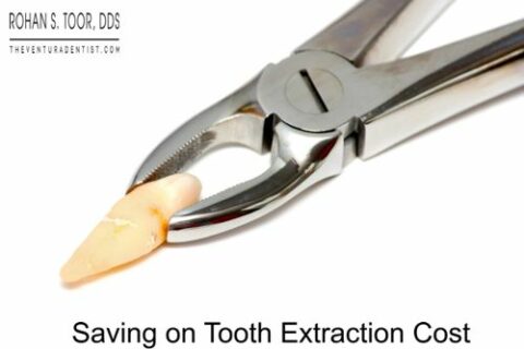 Saving on Tooth Extraction Cost