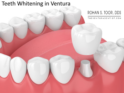 Teeth Whitening in Ventura