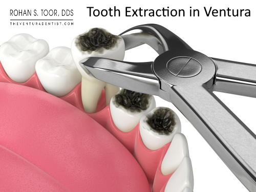 Dental Extraction in Ventura
