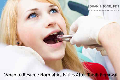 When to Resume Normal Activities After Tooth Removal