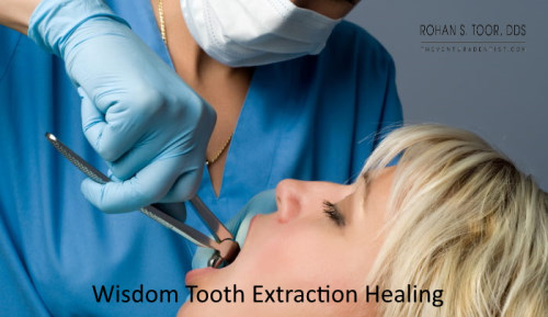 Wisdom Tooth Extraction Healing